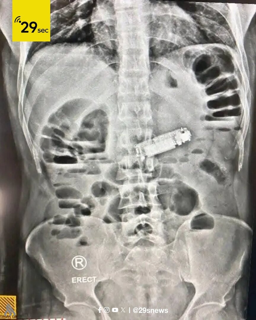 مۆبایلێک لە گەدەی كەسێک دەرهێنرا